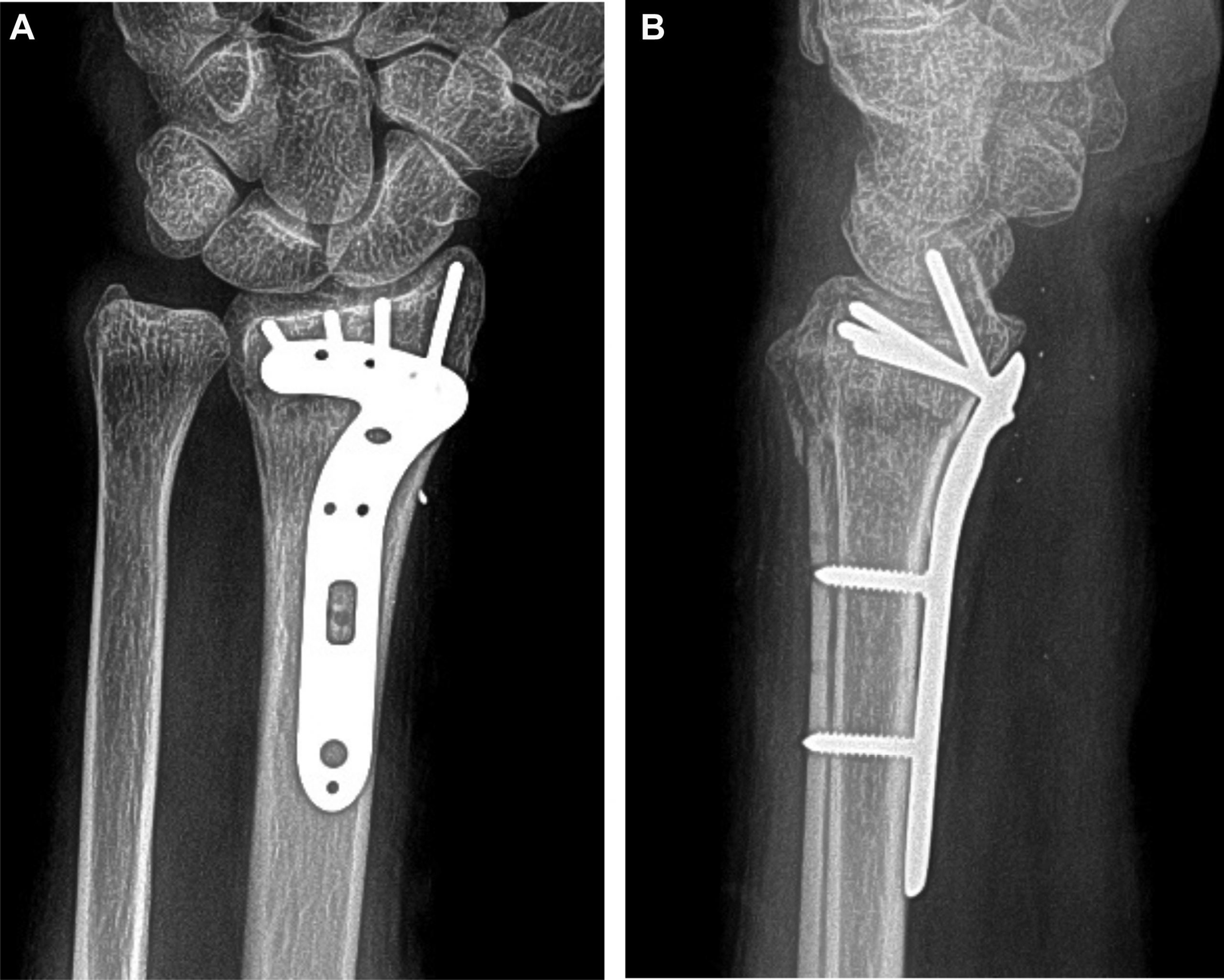 FDA approves Orthofix's ultrasonic bone fracture healing system